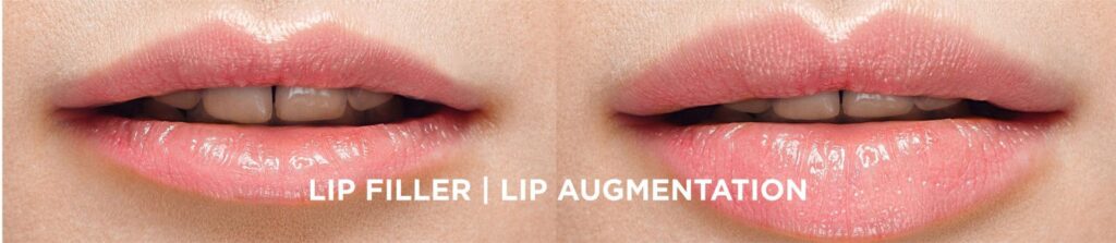 Best Lip Fillers in Delhi, India for Gorgeous Lips - Dr Reema Arora