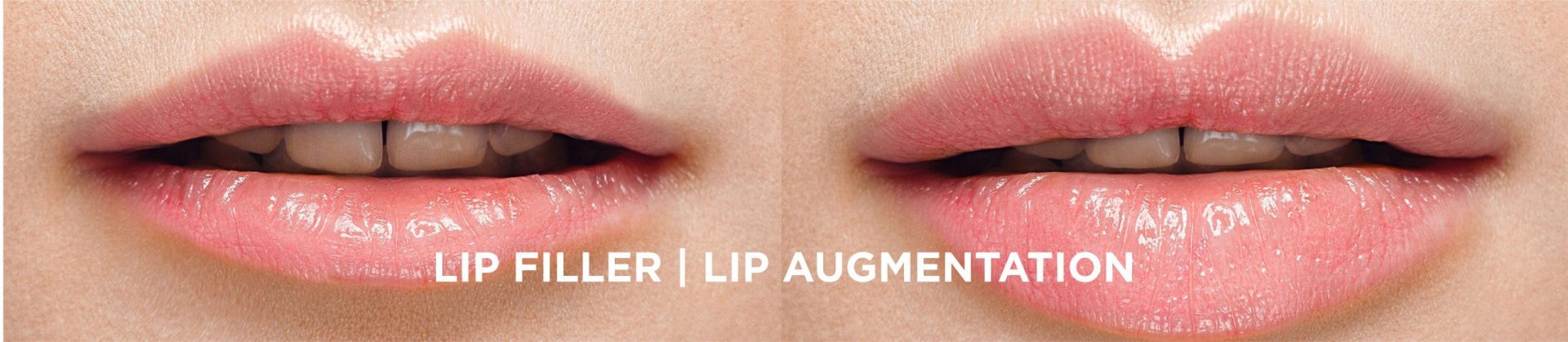 Best Lip Fillers in Delhi, India for Gorgeous Lips - Dr Reema Arora