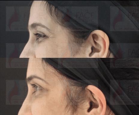 Botox crows feet before and after pictures