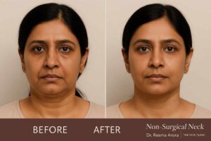 Minimally Invasive Neck Lift Before and After