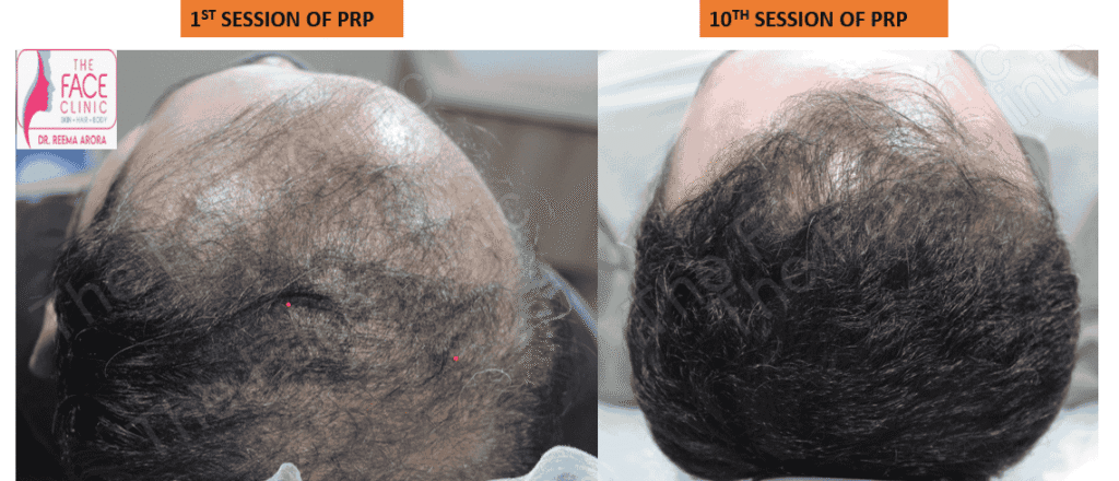 Advanced PRP therapy for hair loss in Delhi clinic