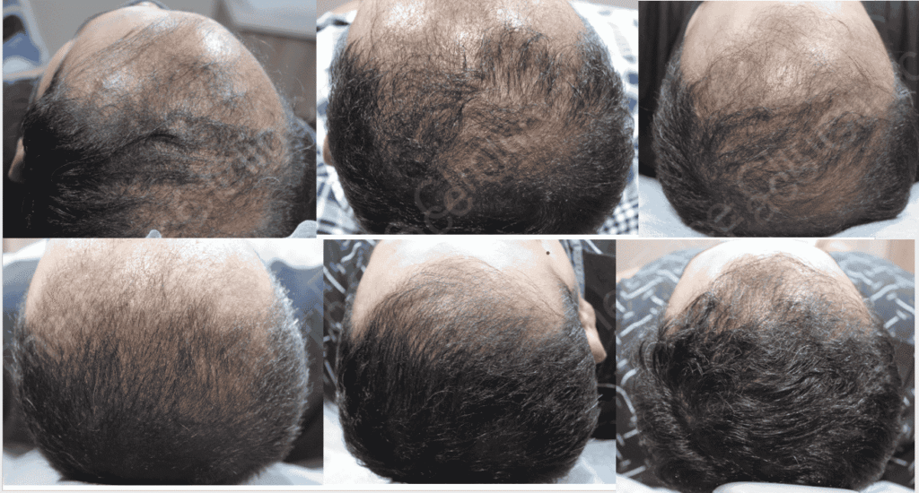 Scalp rejuvenation and hair regrowth laser therapy Delhi