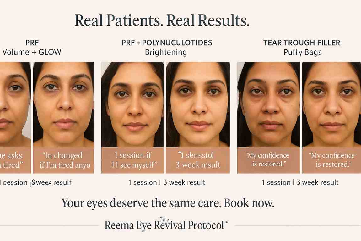 Dark Circles Results