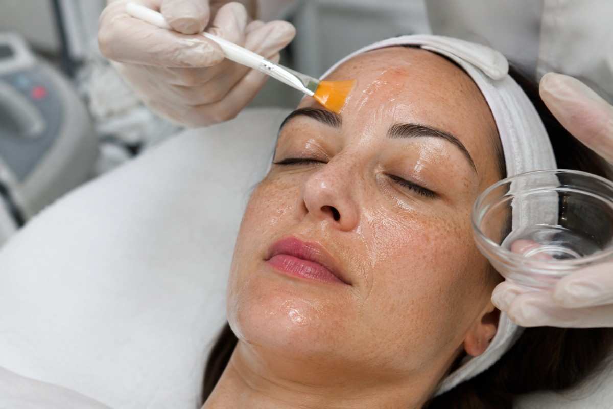 Chemical Peel Treatment