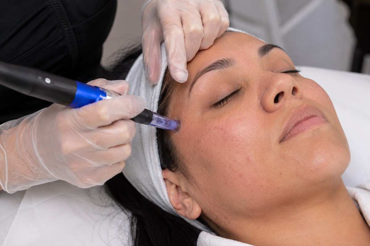 Microneedling Treatment
